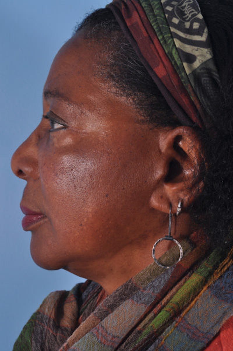 Mustache, Eyebrow Grafts Before & After Gallery - Patient 108555 - Image 3