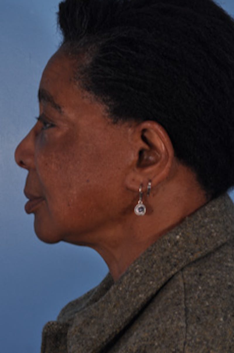 Mustache, Eyebrow Grafts Before & After Gallery - Patient 108555 - Image 4