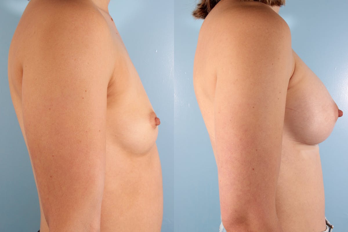 Breast Augmentation Before & After Gallery - Patient 344866 - Image 2