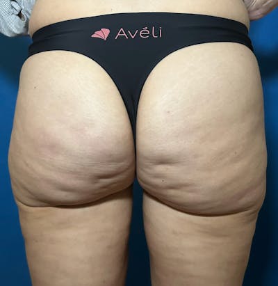 Avéli Cellulite Treatment Before & After Gallery - Patient 452557 - Image 1