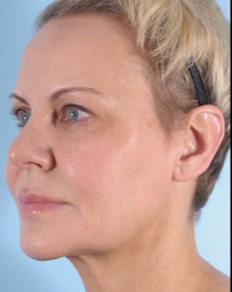 Ultherapy Before & After Gallery - Patient 141290 - Image 1