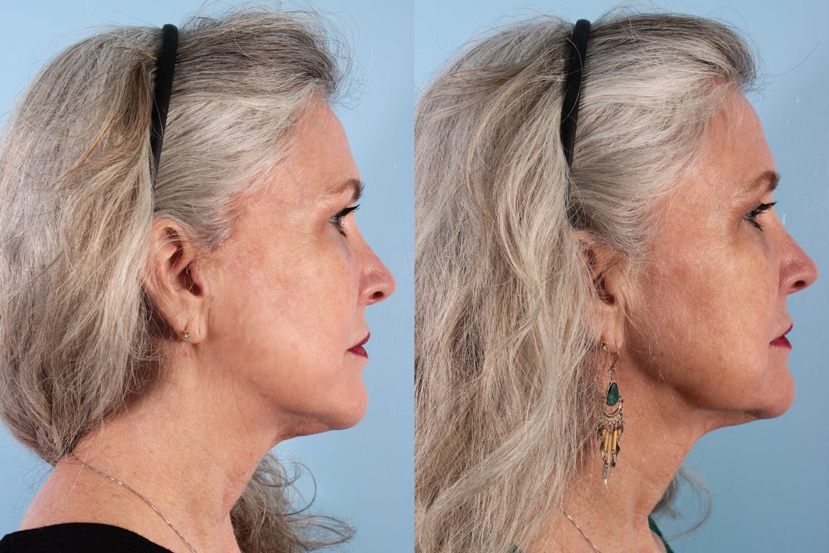 Thread Lift Before & After Gallery - Patient 400135 - Image 1