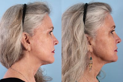 Thread Lift Before & After Gallery - Patient 400135 - Image 1