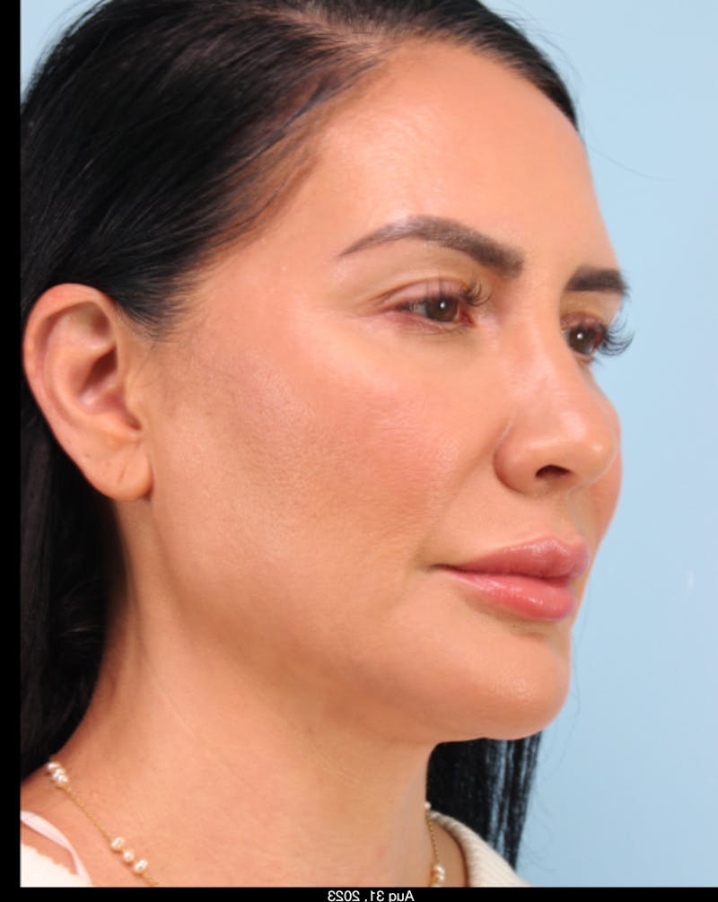 Thread Lift Before & After Gallery - Patient 153056 - Image 6