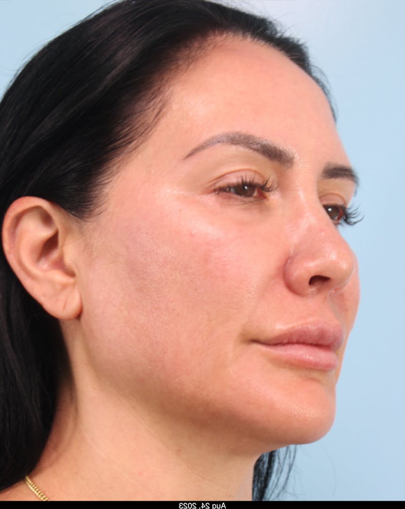 Thread Lift Before & After Gallery - Patient 153056 - Image 5