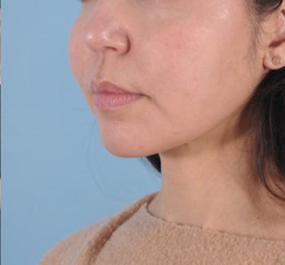 Silhouette Lift Before & After Gallery - Patient 183271 - Image 1