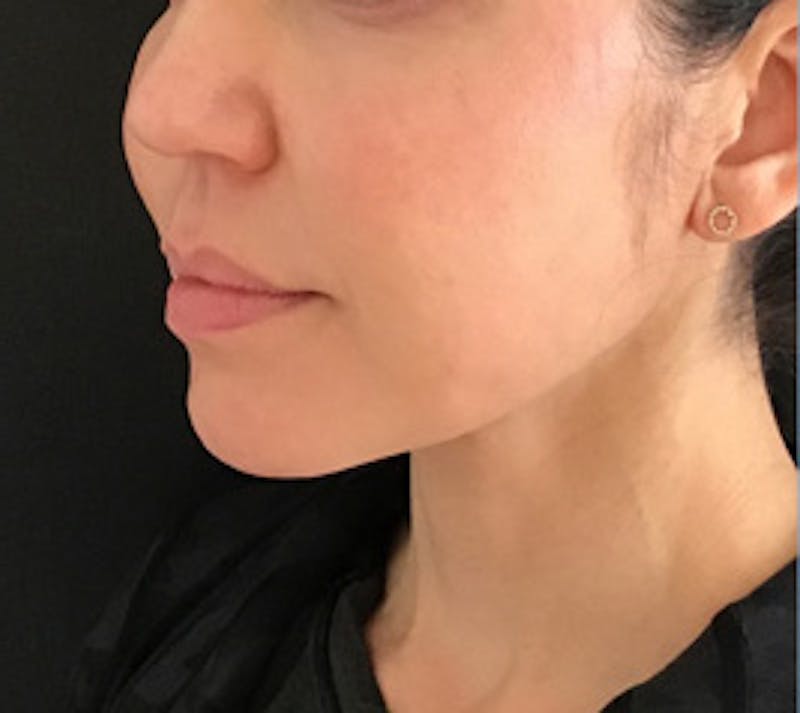 Silhouette Lift Before & After Gallery - Patient 183271 - Image 2