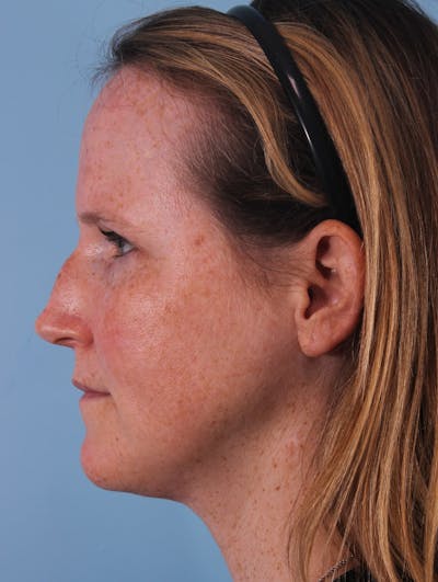 Rhinoplasty Before & After Gallery - Patient 415773 - Image 1