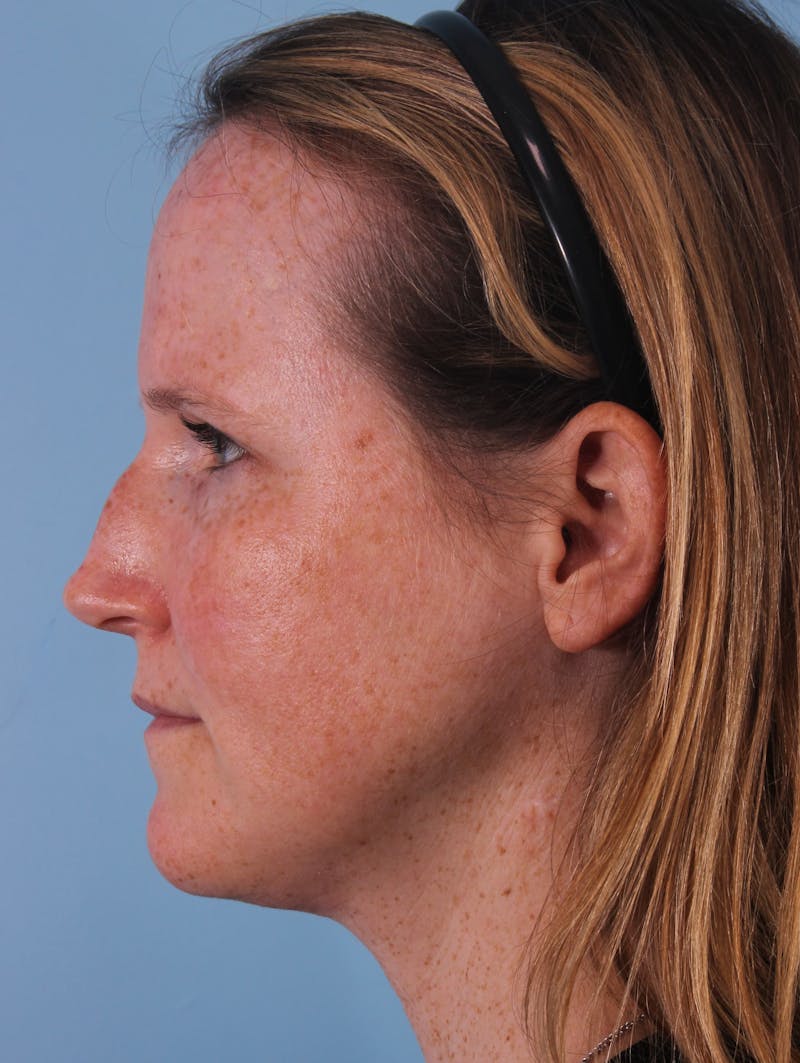 Rhinoplasty Before & After Gallery - Patient 415773 - Image 1