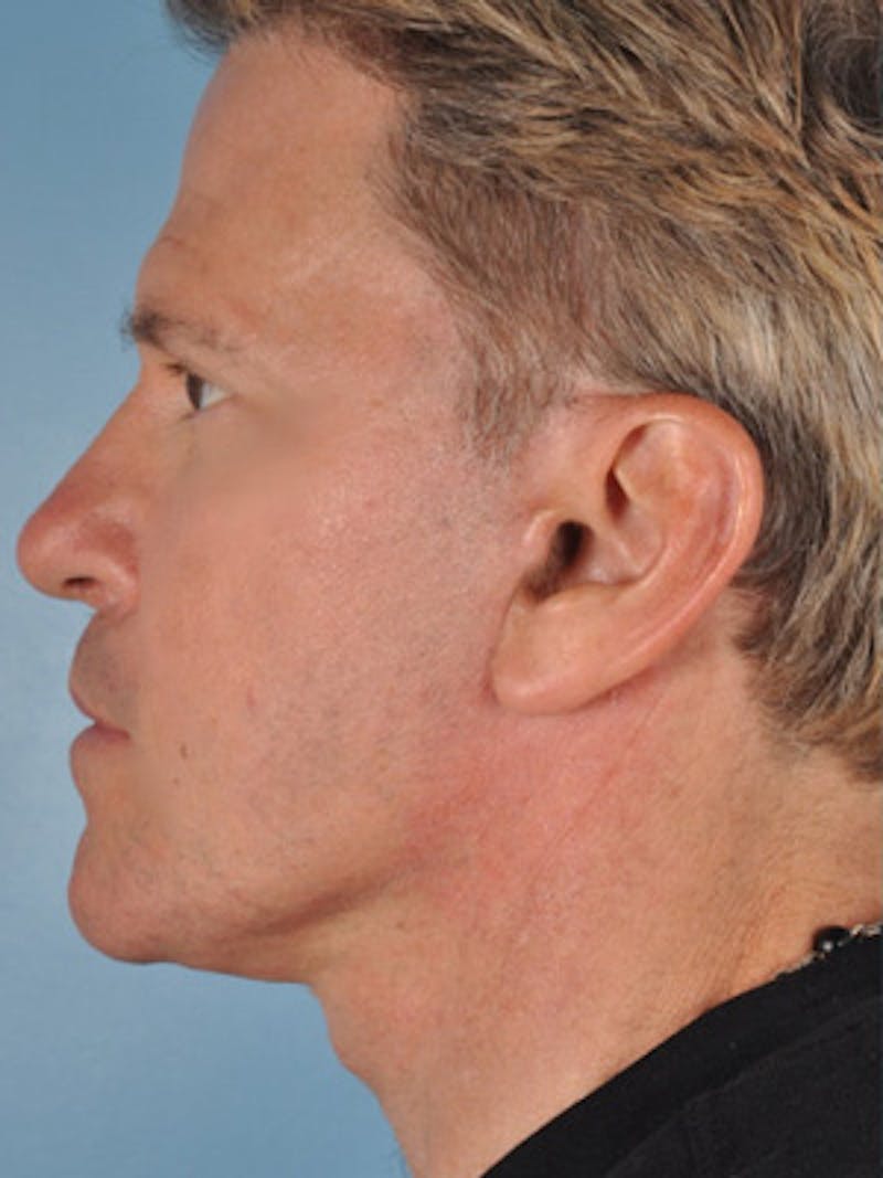 Lip Lift / Implants Before & After Gallery - Patient 124565 - Image 4