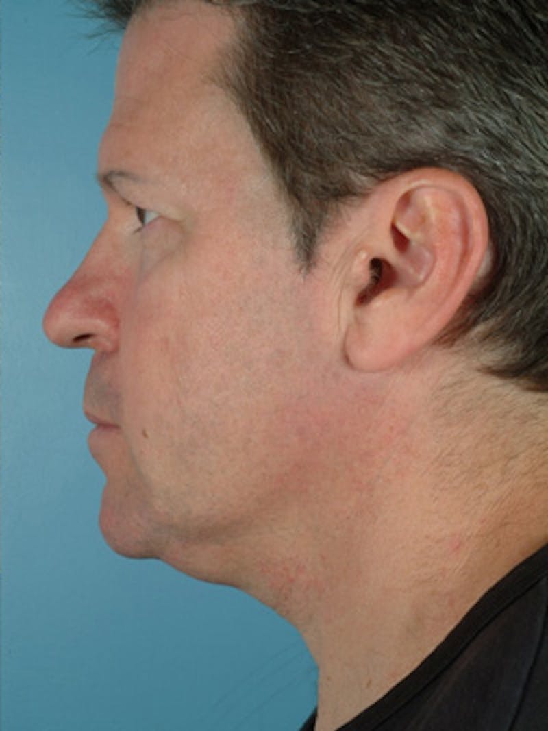 Lip Lift / Implants Before & After Gallery - Patient 124565 - Image 3