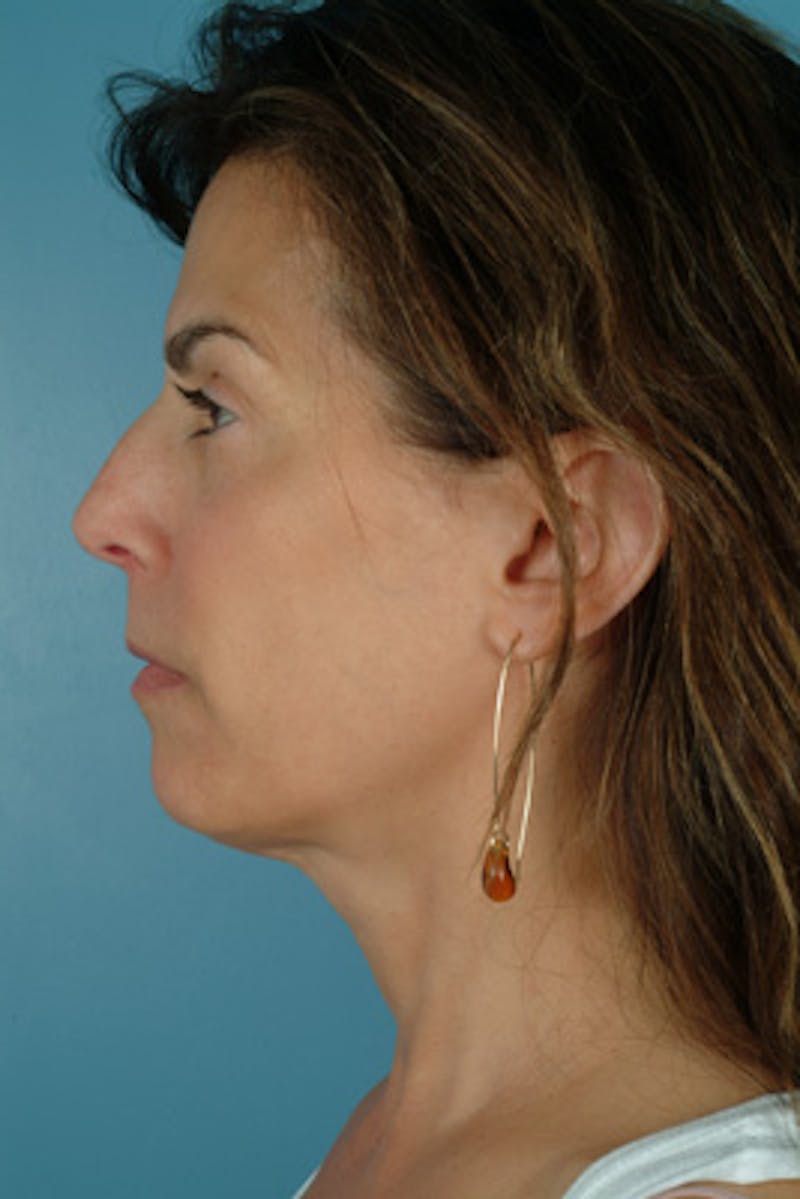 Rhinoplasty Before & After Gallery - Patient 373528 - Image 1