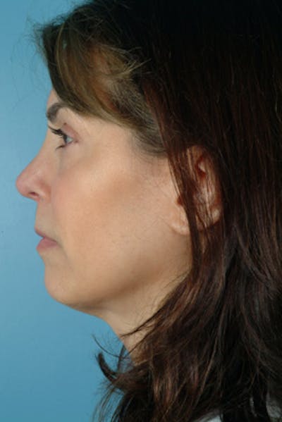 Rhinoplasty Before & After Gallery - Patient 373528 - Image 2