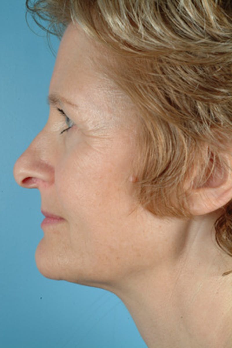 Rhinoplasty Before & After Gallery - Patient 358324 - Image 1