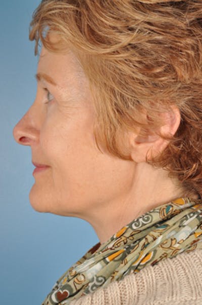 Rhinoplasty Before & After Gallery - Patient 358324 - Image 2