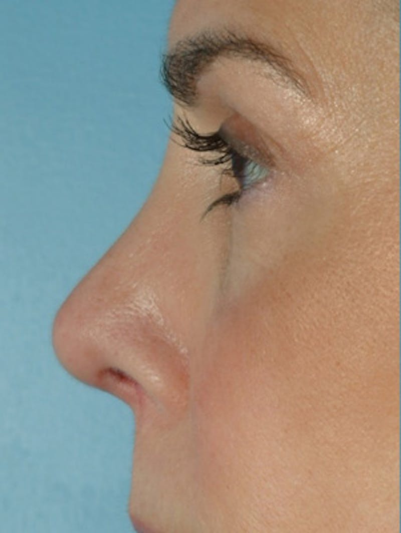 Rhinoplasty Before & After Gallery - Patient 280890 - Image 2