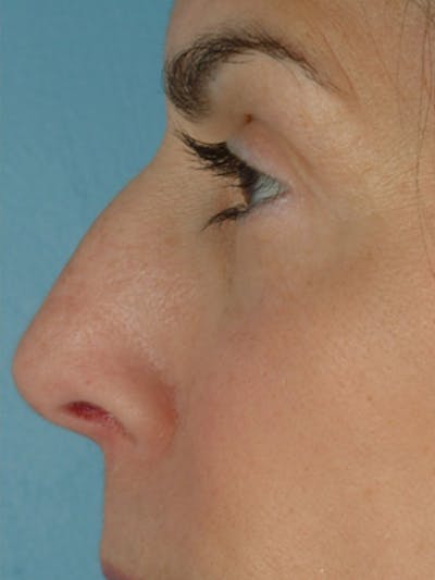 Rhinoplasty Before & After Gallery - Patient 280890 - Image 1