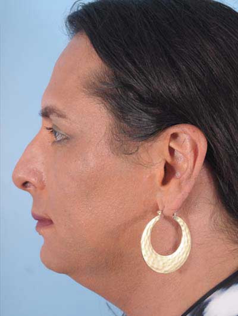 Rhinoplasty Before & After Gallery - Patient 152192 - Image 1