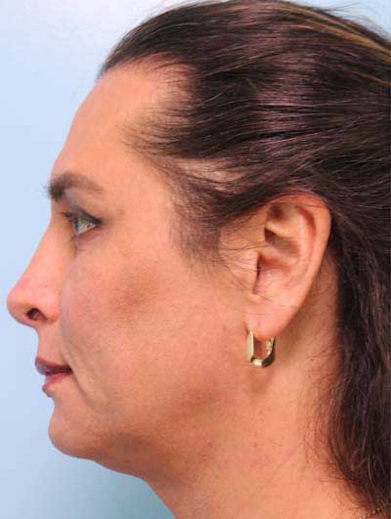 Rhinoplasty Before & After Gallery - Patient 152192 - Image 2