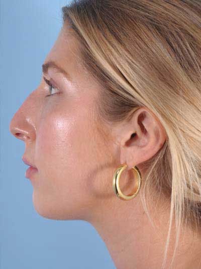 Rhinoplasty Before & After Gallery - Patient 764396 - Image 1