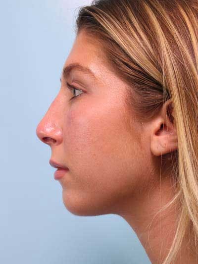 Rhinoplasty Before & After Gallery - Patient 764396 - Image 2