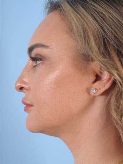 Rhinoplasty Before & After Gallery - Patient 291754 - Image 1