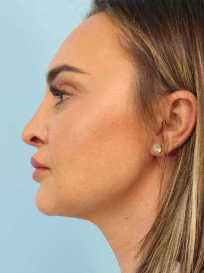 Rhinoplasty Before & After Gallery - Patient 291754 - Image 2