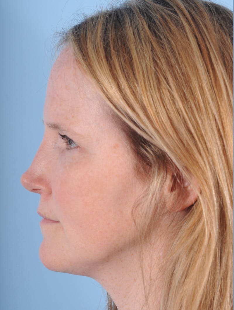 Rhinoplasty Before & After Gallery - Patient 156178 - Image 2