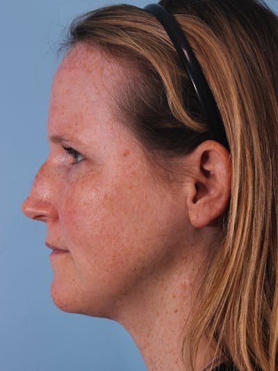 Rhinoplasty Before & After Gallery - Patient 156178 - Image 1
