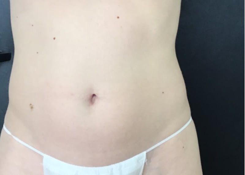 CoolTone Before & After Gallery - Patient 112525 - Image 1