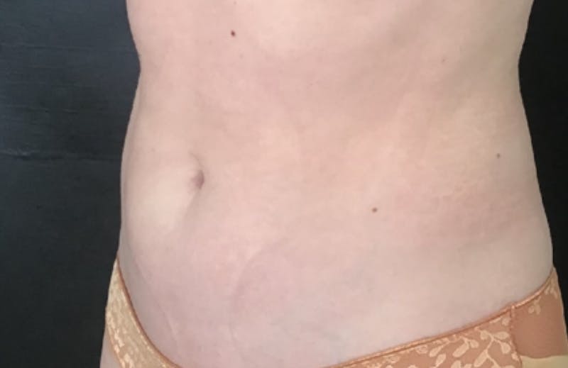 CoolTone Before & After Gallery - Patient 112525 - Image 4