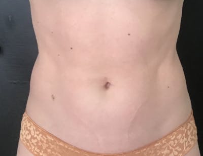 CoolTone Before & After Gallery - Patient 112525 - Image 2