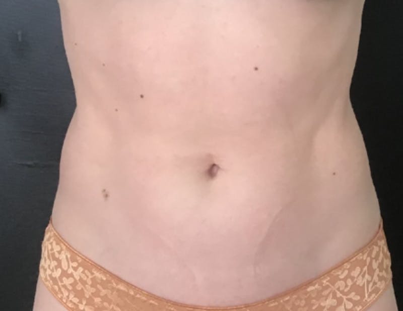 CoolTone Before & After Gallery - Patient 112525 - Image 2