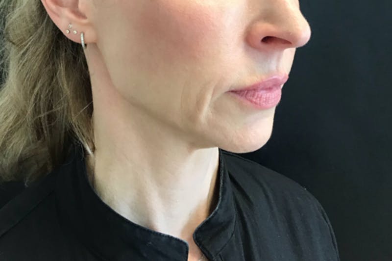 Dermal Fillers Before & After Gallery - Patient 413934 - Image 1