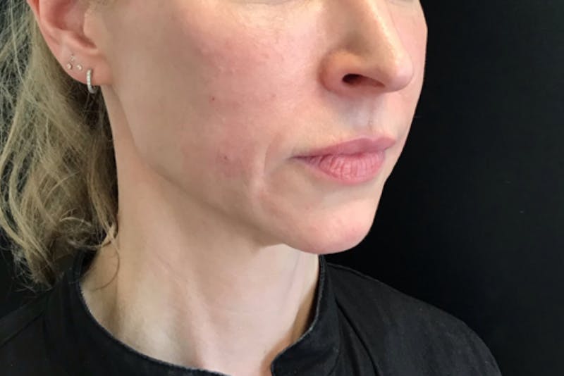 Dermal Fillers Before & After Gallery - Patient 413934 - Image 2