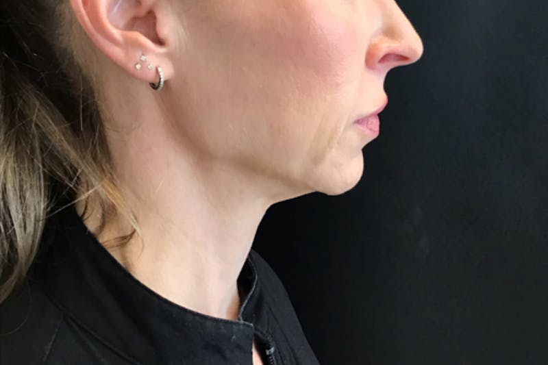 Dermal Fillers Before & After Gallery - Patient 413934 - Image 3