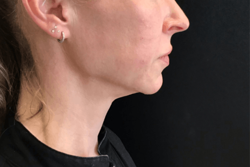 Dermal Fillers Before & After Gallery - Patient 413934 - Image 4