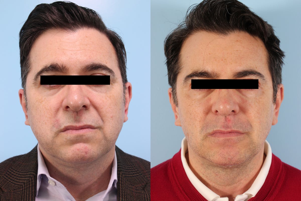 Buccal Fat Removal Before & After Gallery - Patient 311478 - Image 1