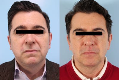 Buccal Fat Removal Before & After Gallery - Patient 311478 - Image 1