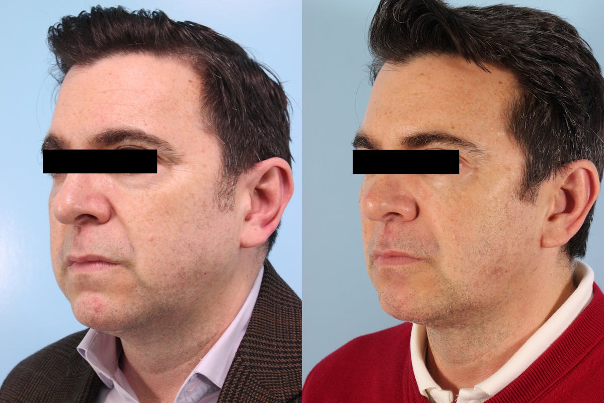Buccal Fat Removal Before & After Gallery - Patient 311478 - Image 2