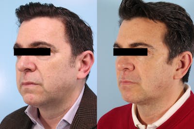 Liposuction Submental Before & After Gallery - Patient 422406 - Image 1