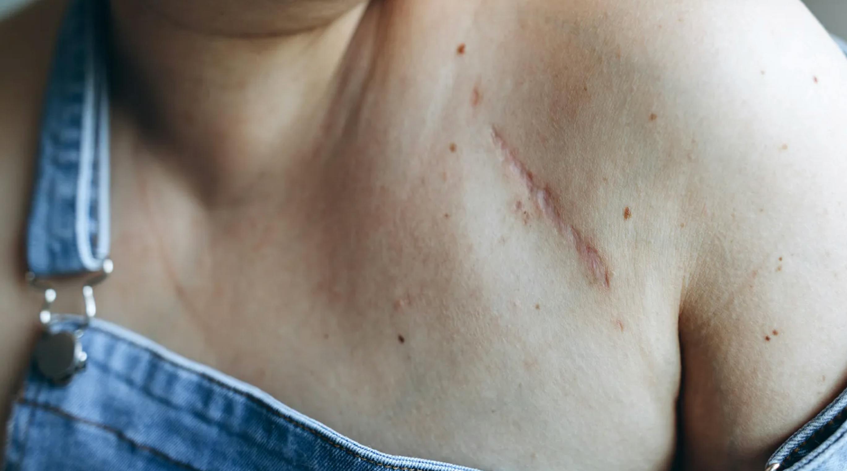 Why Scars Never Disappear