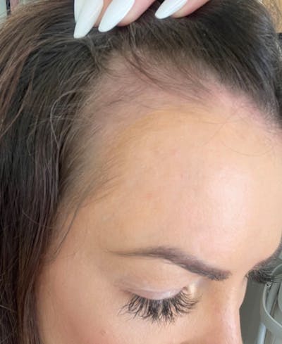 PRP Hair Restoration Before & After Gallery - Patient 595057 - Image 1