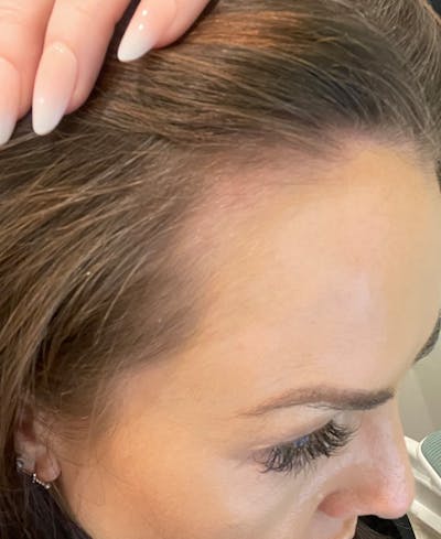 PRP Hair Restoration Before & After Gallery - Patient 595057 - Image 2
