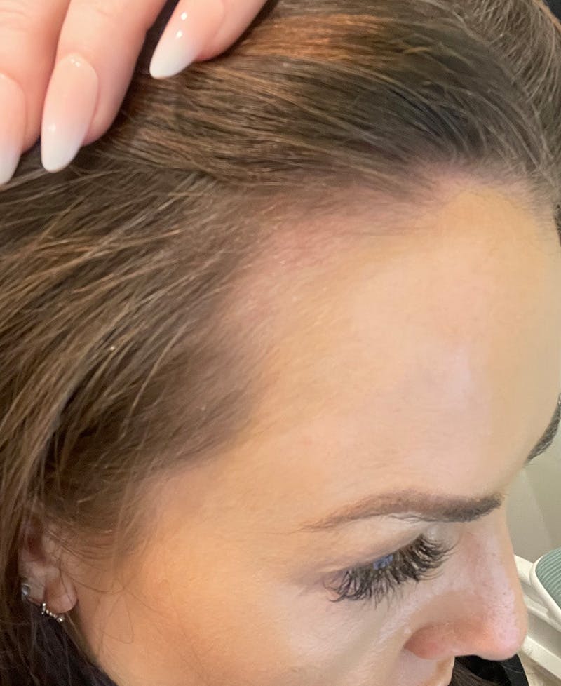 PRP Hair Restoration Before & After Gallery - Patient 595057 - Image 2