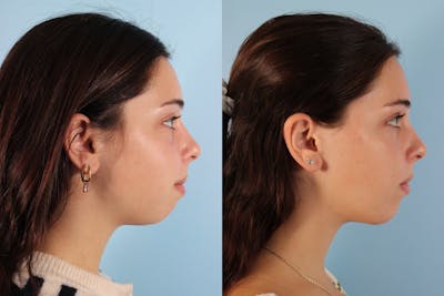 Chin Implant Before & After Gallery - Patient 229476 - Image 1