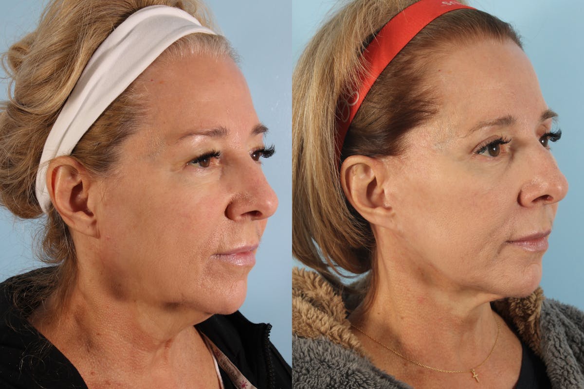 Upper Blepharoplasty Before & After Gallery - Patient 218987 - Image 1
