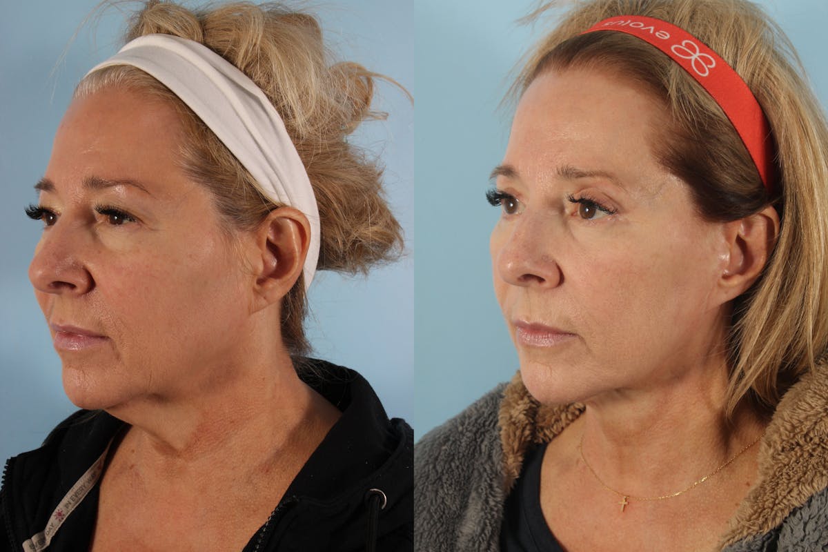 Upper Blepharoplasty Before & After Gallery - Patient 218987 - Image 2