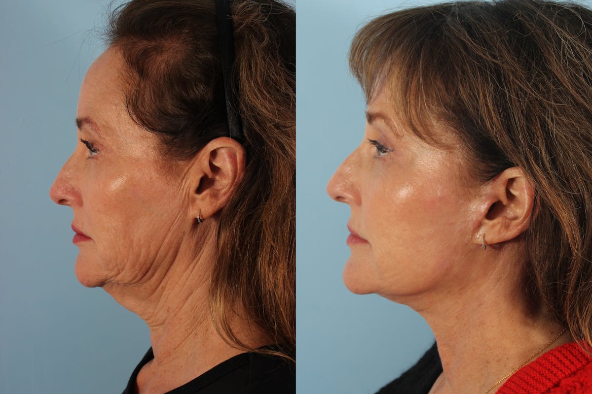 Facelift Surgery Before & After Gallery - Patient 414791 - Image 3
