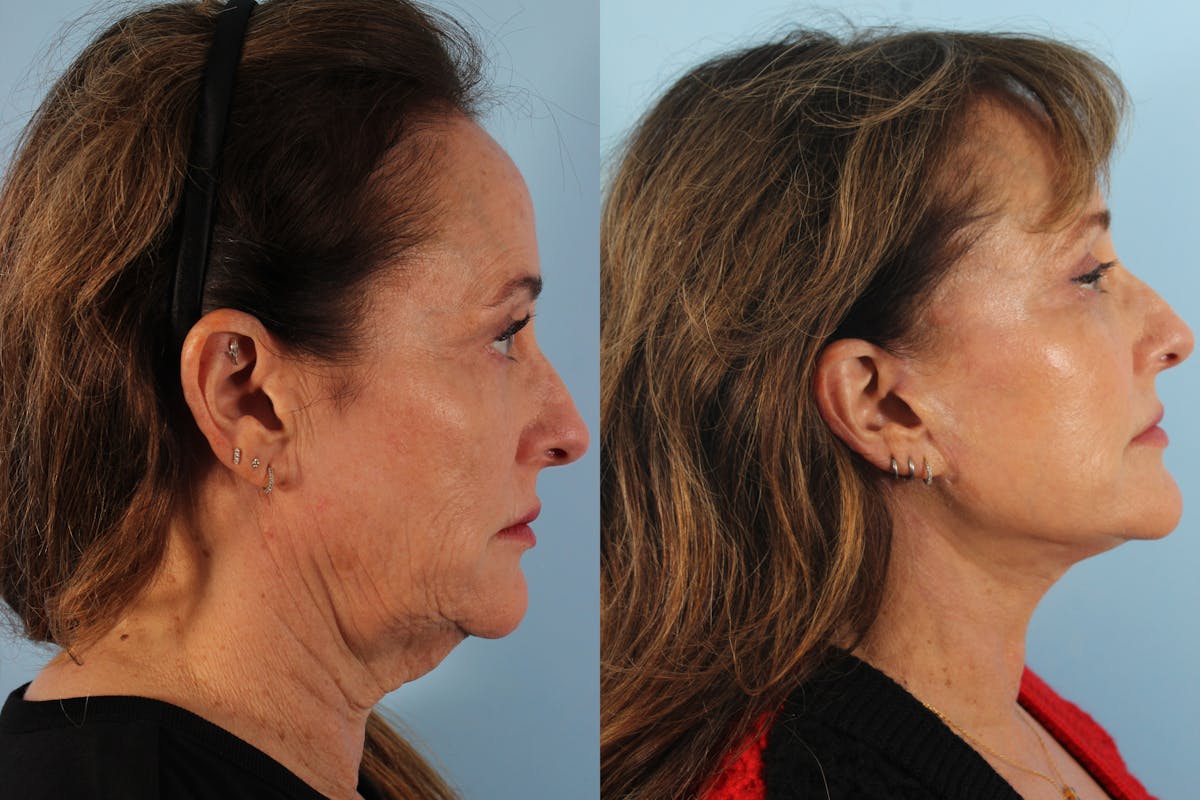 Facelift Surgery Before & After Gallery - Patient 414791 - Image 2